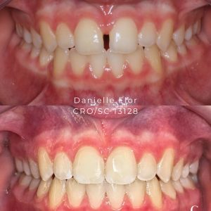 O detalhe que faz toda a diferença: Fechamento de Diastema com Alinhadores